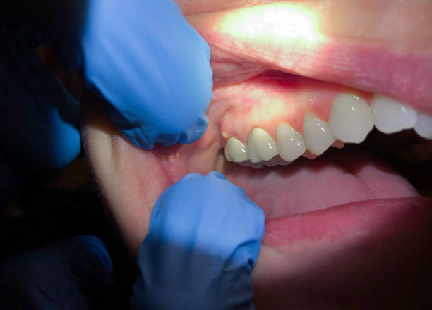 Best Emergency Dental Extractions in Jacksonville, TX