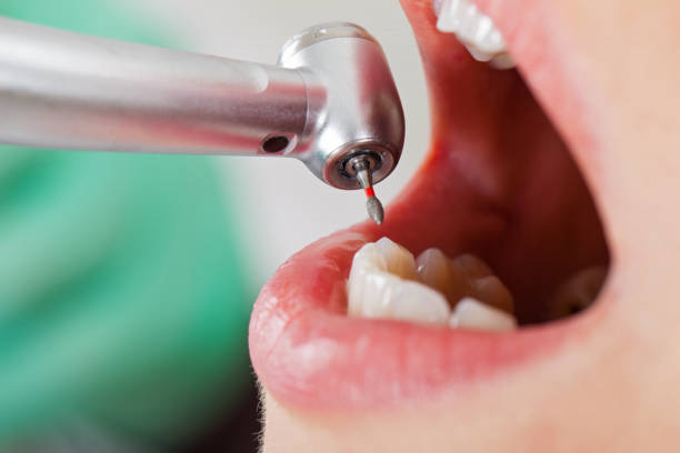 Best Emergency Dentist for Lost Fillings or Crowns in Jacksonville, TX